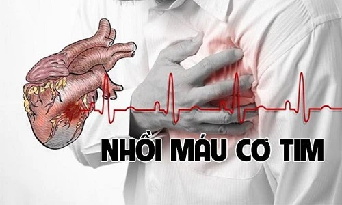 Loạt dấu hiệu nhận biết nhanh của nhồi máu cơ tim