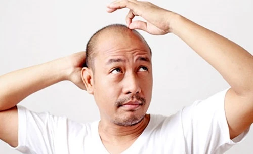 5 căn bệnh đàn ông hói đầu dễ mắc phải