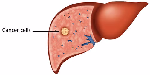 Ăn cá nấu chưa chín có thể gây bệnh ung thư gan