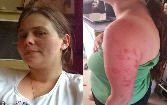 Cô gái “ma cà rồng” cứ ra nắng là lở da, chảy nước