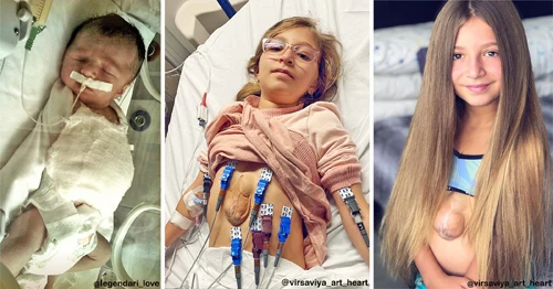 Câu chuyện kỳ diệu về bé gái có trái tim ngoài lồng ngực