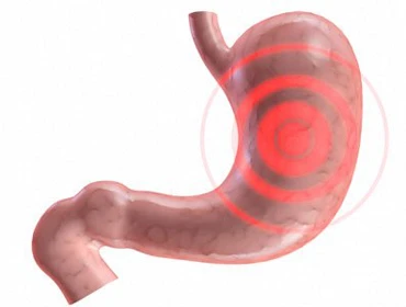 13 dấu hiệu bạn bị viêm dạ dày