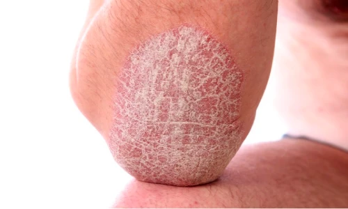 7 bài thuốc dân gian chữa bệnh vảy nến hiệu quả