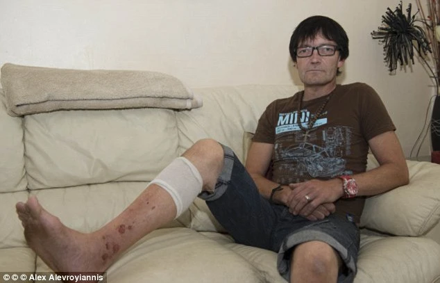 Cận cảnh phồng rộp da chân khủng khiếp vì mùi tây