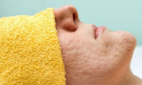 Những nguyên nhân không ngờ khiến bạn sở hữu lỗ chân lông to