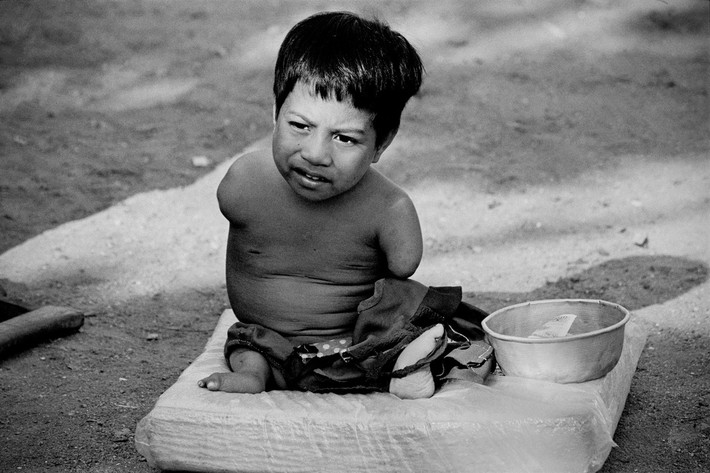 Em Pheak, 12 tuổi, sinh ra ở phía Đông của tỉnh Prey Veng, gần biên với Campuchia - Việt Nam với 4 chi bị cụt. Em được cha mẹ đưa lên Phnom Penh để hành nghề ăn xin, 1995. Ảnh: Philip Jones Griffiths - Magnumphotos.com