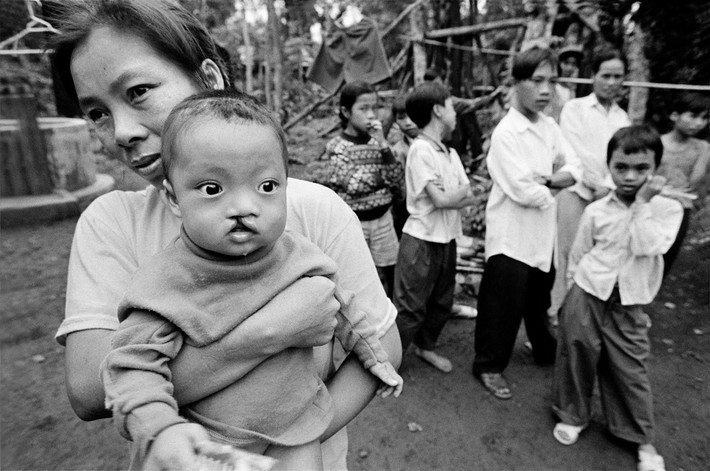 Em Hoằng Hữu Cung, chín tháng tuổi, bị hở hàm ếch từ khi sinh. Bố mẹ em đã cùng nhau chiến đấu trong một khu vực bị rải chất độc da cam thời kháng chiến chống Mỹ. Hai đứa con lớn của họ không có biểu hiện bất thường, 1998. Ảnh: Philip Jones Griffiths - Magnumphotos.com