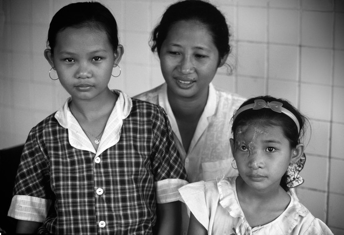 Tỉnh Sông Bé, làng Uyên Hưng. Em Trần Thị Cẩm Nhung (bên phải) đứng cùng mẹ và chị gái tại nhà ở tỉnh Sông Bé. Nhung khỏe mạnh khi mới sinh, chỉ sau một tuần da trên mắt phải chuyển sang màu đỏ và phát triển thành khổi u khổng lồ to bằng quả bưởi. Sau một năm điều trị và phẫu thuật ở Đức, khối u đã được loại bỏ hoàn toàn nhưng để lại sẹo vĩnh viễn trên khuôn mặt, 1994. Ảnh: Philip Jones Griffiths - Magnumphotos.com
