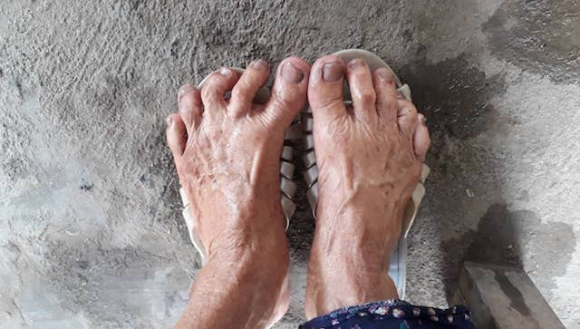 Theo một cách lý giải khác, bàn chân Giao Chỉ hình thành do biến dị ở xương. Hiện tượng này không chỉ có ở Việt Nam mà còn xuất hiện ở nhiều nhóm dân tộc khác như Mã Lai, Thái Lan, Trung Quốc, Ả Rập, người bản địa châu Phi... chỉ khác nhau ở mức độ. Ảnh: Tinhuyquangtri.vn.