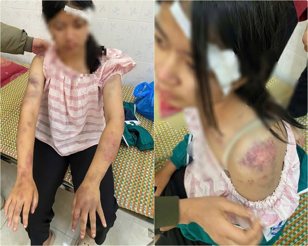 Cháu P.A với nhiều vết bầm tím trên cơ thể. (Ảnh: CA Thái Nguyên). page.jpg