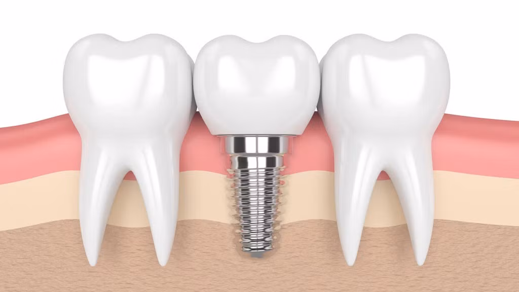 trong-rang-implant-co-dau-khong.jpg