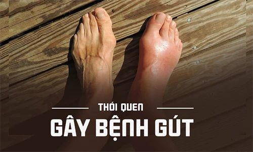 Video: Thói quen sai lầm “tiếp tay” cho bệnh gút phát triển mạnh