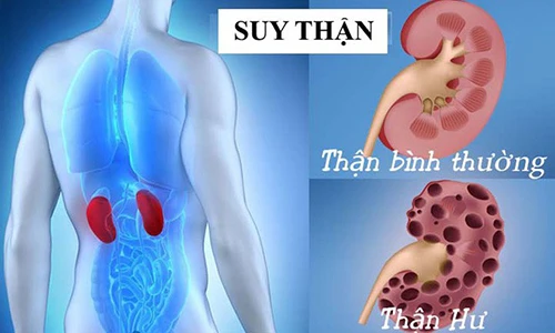 Video: Làm ngay 4 điều này để phòng bệnh thận