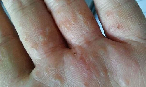 Video: Ghẻ nước, căn bệnh dễ mắc phải trong thời tiết hiện nay