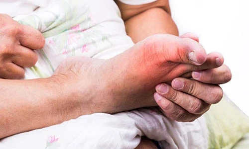 Video: Trên 30 tuổi, nếu có dấu hiệu này cần phải cảnh giác với bệnh gút