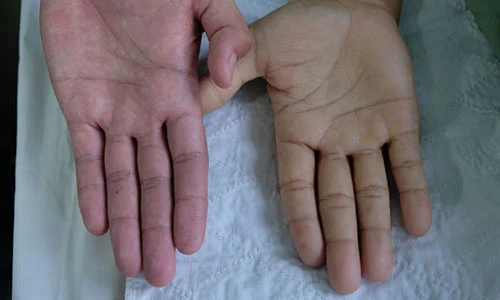 Video: 7 dấu hiệu thiếu máu cứ ngỡ thường thôi, đến lúc phát hiện thì...