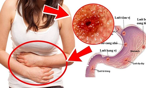 Video: Bài thuốc trị viêm loét dạ dày chỉ 7 ngày là khỏi