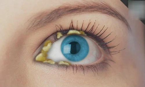 Video: Ghèn xuất hiện nhiều vào buổi sáng là dấu hiệu bệnh chớ bỏ qua