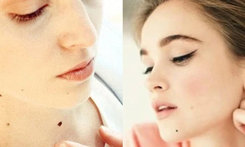 Video: Chỉ cần xóa nốt ruồi này tài lộc đầy nhà, giàu sang ập tới