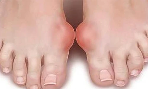 Video: Bệnh Gút nên ăn gì để thải lượng acid uric?