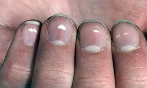 Video: Đốm trắng trên móng tay “tố” bệnh gì?