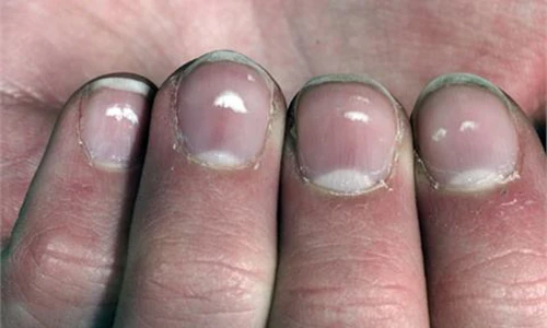 Video: Đốm trắng trên móng tay “tố” bệnh gì?