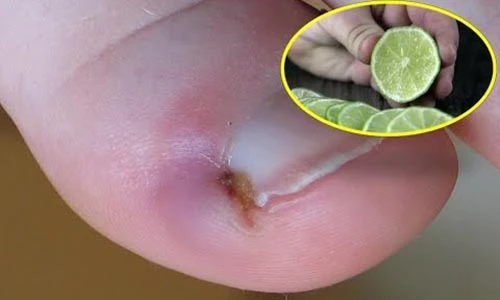 Video: 4 cách đơn giản chữa chín mé tay chân nhanh gọn tại nhà