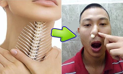 Video: Mẹo chữa hóc xương cá chỉ... 1 phút 30 giây