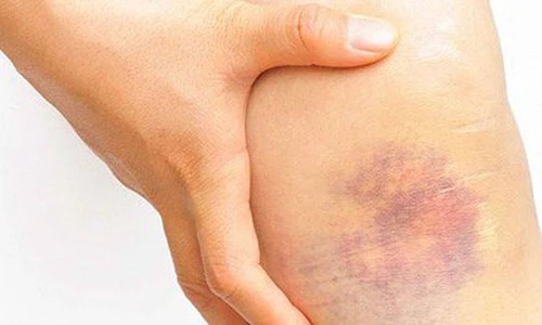 Video: 8 nguyên nhân không ngờ khiến bạn bị bầm tím cơ thể