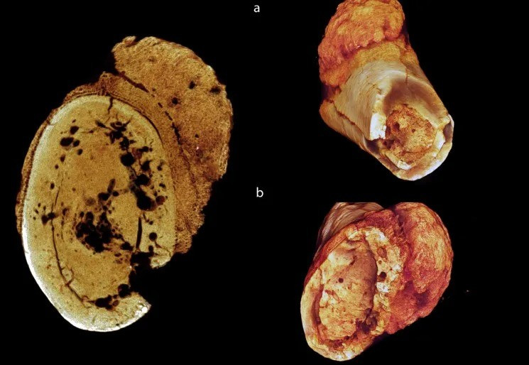 Theo Hiệp hội Ung thư Mỹ, ngày nay, osteosarcoma là một trong những bệnh ung thư xương phổ biến nhất ở người và có thể xảy ra ở mọi lứa tuổi nhưng thường gặp nhất ở trẻ em, thanh thiếu niên và người trẻ. Ảnh: Edward Odes Wits.