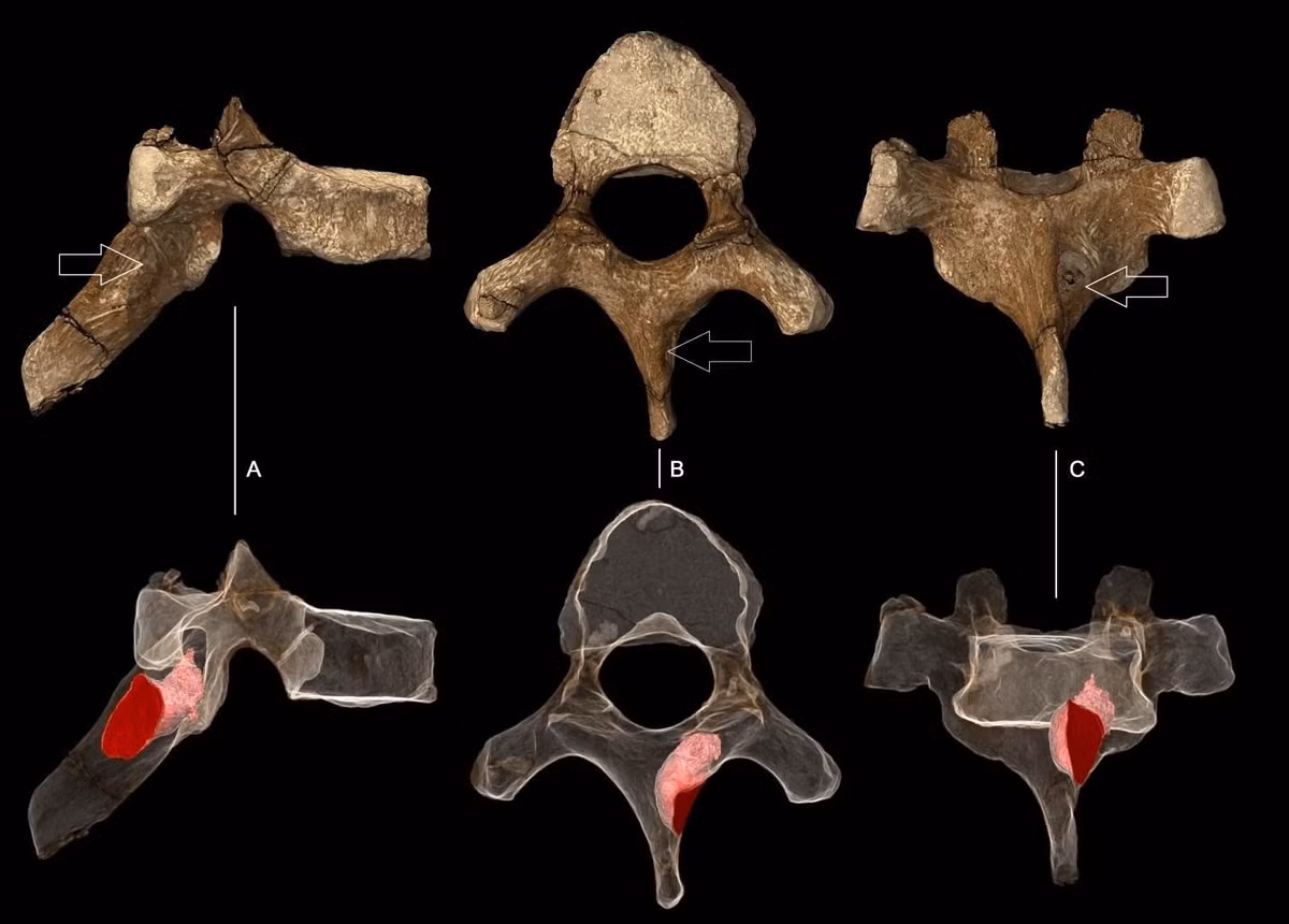 Theo các nhà nghiên cứu, trường hợp ung thư cổ xưa nhất từng ghi nhận nhiều khả năng thuộc loài Paranthropus robustus hoặc Homo ergaster. Người này đã phải sống với khối u ác tính ở xương ngón chân trái. Ảnh: Paul Tafforeau (ESRF).
