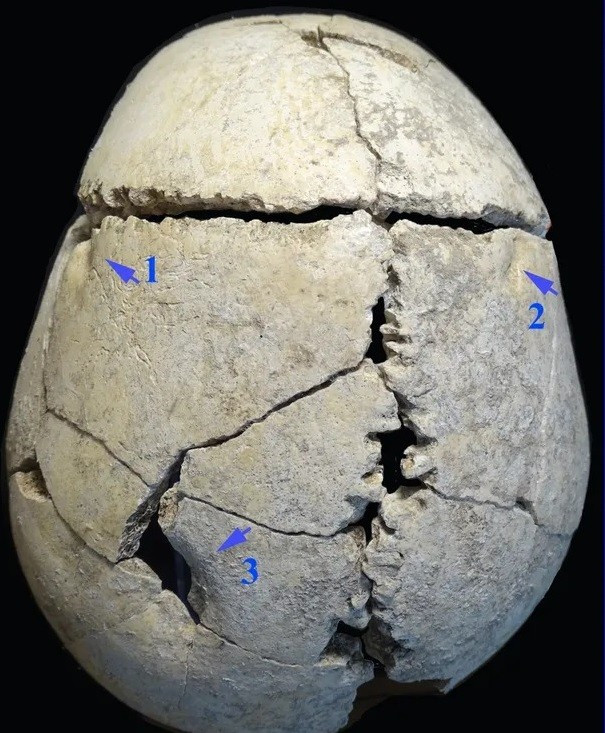 Do bị sư tử tấn công tàn bạo nên nam thiếu niên có những lỗ sâu trên hộp sọ. Điều này cho thấy não bộ của cậu đã bị tổn thương nghiêm trọng. Thế nhưng, cậu vẫn may mắn sống sót sau vụ việc này. Ảnh: Karastoyanova et al. (2025), Journal of Archaeological Science: Reports; CC BY-NC-ND 4.0).