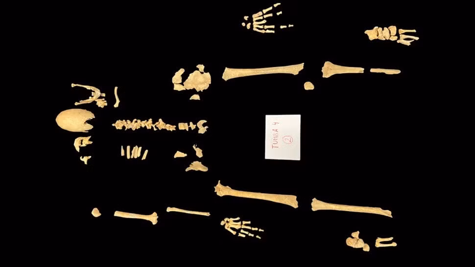 Khi xem xét kỹ hơn bộ hài cốt, các nhà nghiên cứu bị sốc bởi hộp sọ dài và hẹp bất thường của ông. Họ nghi ngờ đó là hậu quả của một tình trạng di truyền thường gây tử vong ở trẻ em. "Tôi rất ngạc nhiên. Tôi chưa bao giờ thấy hộp sọ nào như thế này trước đây, đặc biệt là hộp sọ của một hiệp sĩ", nhà nhân chủng học sinh học Carme Rissech tại Đại học Rovira i Virgili ở Tây Ban Nha, chia sẻ. Ảnh: Rissech et al. / Heritage / CC-BY 4.0.