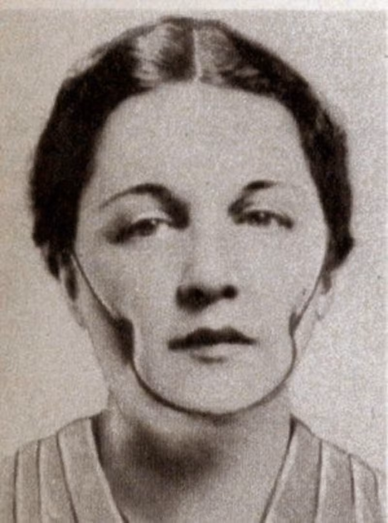 Thiết bị tạo má lúm đồng tiền được sáng chế vào năm 1936. Sáng chế này được khuyến cáo sử dụng vào ban đêm.