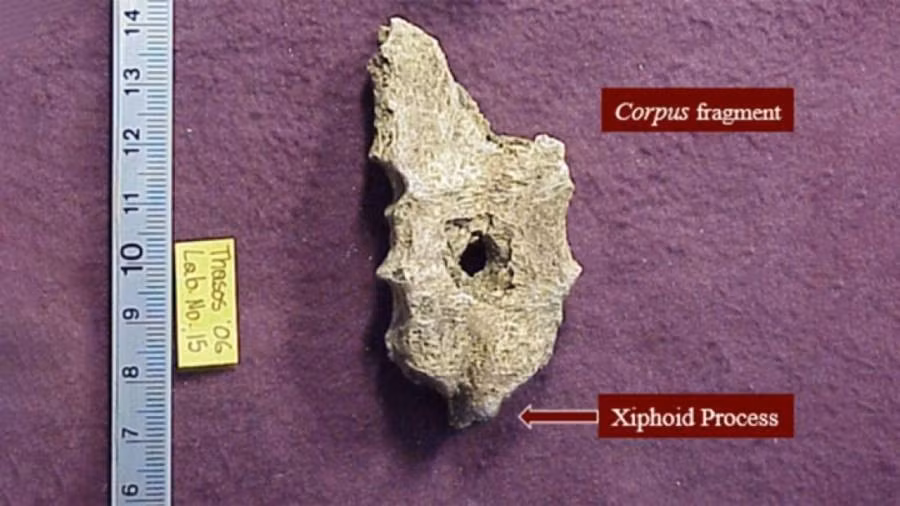 Khi một nhóm các nhà khảo cổ học phát hiện hài cốt của 57 người ở mọi lứa tuổi tại một địa điểm khai quật trên đảo Thasos của Hy Lạp, một thi hài thu hút sự chú ý của họ. Nguyên do là trên bộ hài cốt này có một lỗ gần như hình tròn hoàn hảo trên xương ức. Ảnh: Anagnostis Agelarakis/ Access Archaeology.