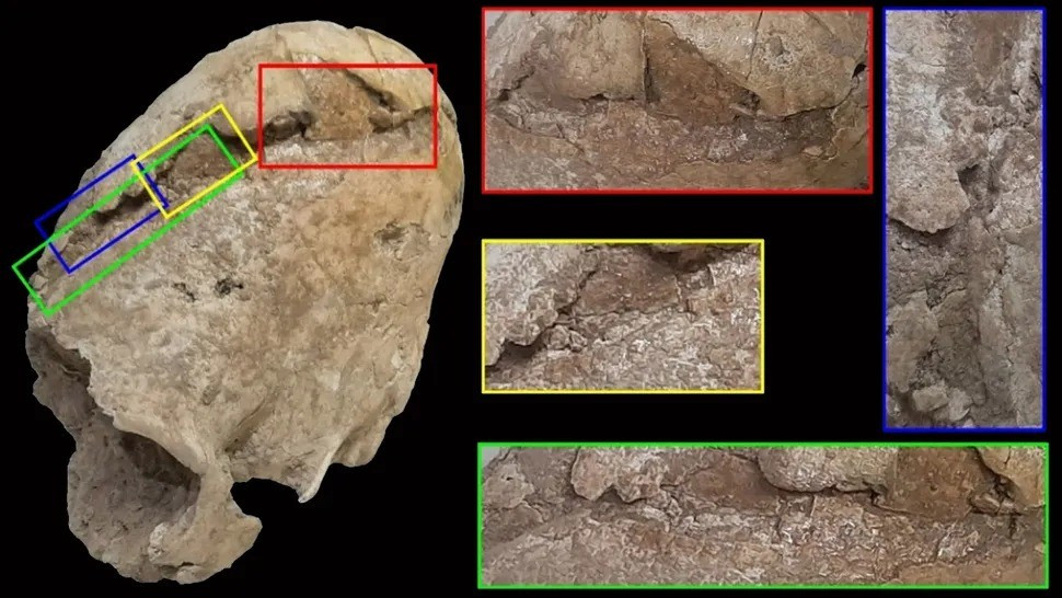 Hộp sọ hình nón của người phụ nữ cho thấy cô bị giết bởi một vật thể có cạnh rộng, nhanh chóng kết thúc cuộc đời ngắn ngủi của cô. Tuy nhiên, giới nghiên cứu chưa thể xác định cú đánh đó có phải là cố ý hay không. Ảnh: Mahdi Alirezazadeh.