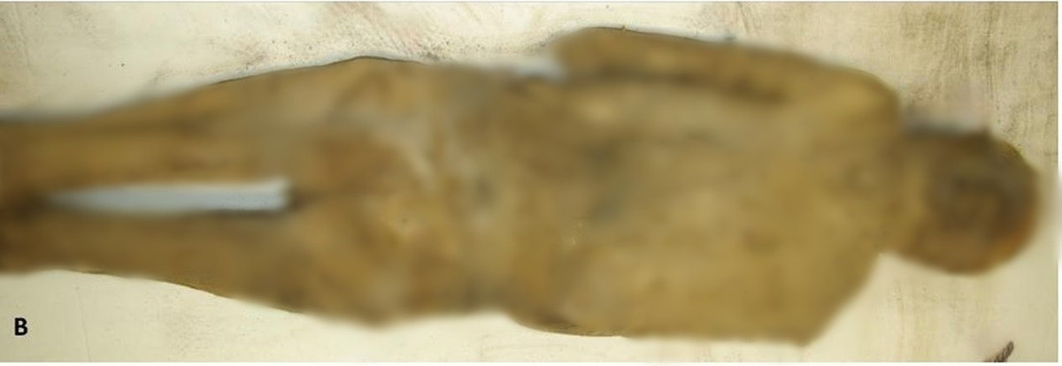 Trải qua hàng trăm năm, xác ướp của "giáo sĩ phơi khô" vẫn trong tình trạng đặc biệt tốt tới mức da và mô còn nguyên vẹn. Trong suốt nhiều năm, các chuyên gia cố gắng xác định danh tính và nguyên nhân cái chết của vị giáo sĩ vẫn còn là bí ẩn. Ảnh: A. G. Nerlich et al., Frontiers in Medicine (2025).