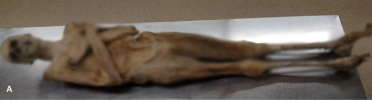 Cụ thể, hầm mộ của nhà thờ St. Thomas am Blasenstein có lưu giữ một xác ướp bí ẩn từ những năm 1700. Thi hài này được người địa phương gọi là "giáo sĩ phơi khô". Ảnh: A. G. Nerlich et al., Frontiers in Medicine (2025).