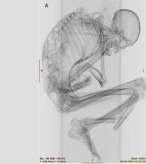 Các chuyên gia đã tiến hành kiểm tra, xác định niên đại thi hài được ướp xác tự nhiên trên. Qua đó, họ nhận định người đàn ông này qua đời cách đây khoảng 1.100 năm và nhiều khả năng tử vong trong một tai nạn khai thác ngọc lam ở Chile thời xưa. Ảnh: Francisco Garrido and Catalina Morales.