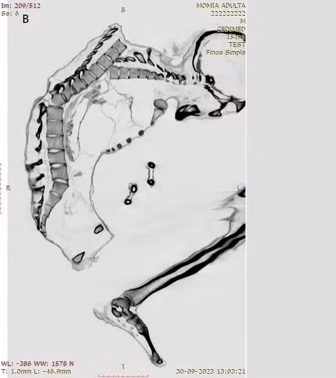 Trên xác ướp có nhiều bằng chứng về chấn thương do lực tác động mạnh cho thấy người đàn ông có thể đã thiệt mạng do đá lở hoặc sập hầm mỏ. Trong nghiên cứu mới công bố, các chuyên gia đã chụp CT và chụp X-quang để giải mã chi tiết những chấn thương nghiêm trọng có thể đã dẫn đến cái chết của người đàn ông trên. Ảnh: Francisco Garrido and Catalina Morales.