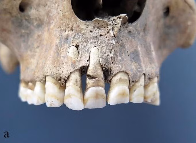 Theo kết quả phân tích, kiểm tra, 7 bộ hài cốt đều thuộc về nam giới trưởng thành. Trong đó, 4 người trẻ tuổi và 3 người trung niên. Một vài người đàn ông đã bị thương trước khi chết, bao gồm chấn thương do vật cùn ở trán, gãy xương sườn và vết thương do vũ khí gây ra. Ảnh: M. Novak et al., PloS One (2025); CC BY 4.0.