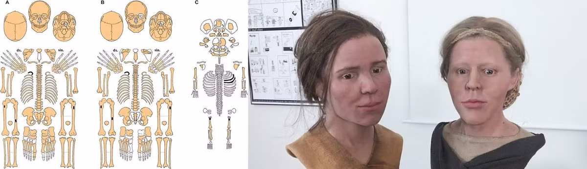 Cẳng tay của người chị có dấu hiệu bị gãy nhưng chỉ mới hồi phục một phần. Đây được xem là bằng chứng cho thấy bà đã bị ép trở lại làm việc khi vết thương chưa lành. Ảnh: Vaníčková et al. 2025.