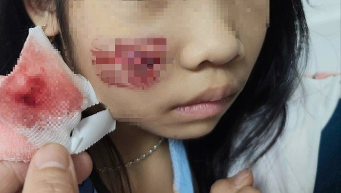 Sáng 13/12/2025, cháu L.Q.N (sinh năm 2018, trú phường Ba Đồn, tỉnh Quảng Trị) nhập viện với vết thương phức tạp vùng mặt và đầu. Theo người nhà cháu N, khi đang chơi ở sân nhà, bất ngờ cháu bị khỉ hoang lao vào tấn công. Ảnh: Người lao động.