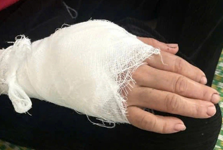 Do bị khỉ đuôi lợn tấn công nên bà P.T.C bị thương ở 2 cánh tay. Người nhà đã nhanh chóng đưa bà đến cơ sở y tế điều trị và khâu 15 mũi. Ảnh: Tiền phong.