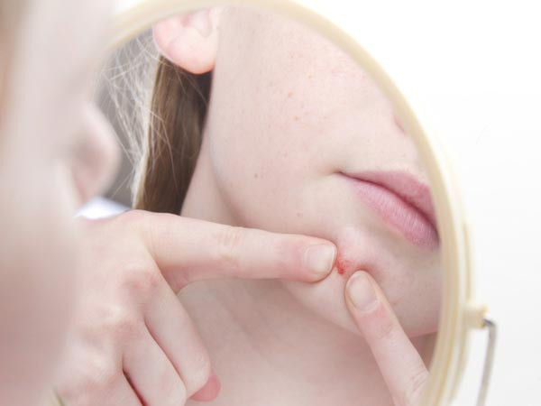 Điều trị mụn nhọt: Nếu gặp phải các vấn đề về mụn, bạn có thể sử dụng gel lô hội để bôi lên nốt mụn. Phương pháp này không chỉ giúp mụn bớt sưng tấy mà còn chống lây lan nhiều hơn.
