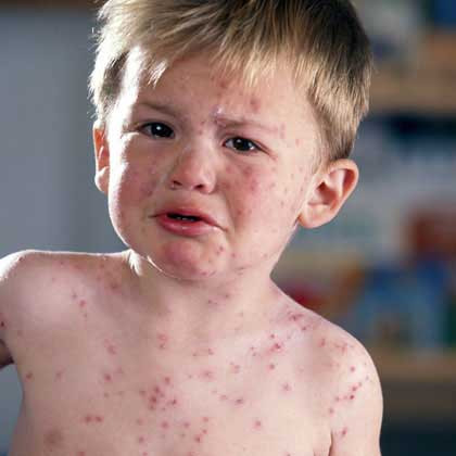Đây cũng là giai đoạn người bệnh dễ mắc các biến chứng nguy hiểm nếu không có sức đề kháng tốt và điều trị đúng cách.