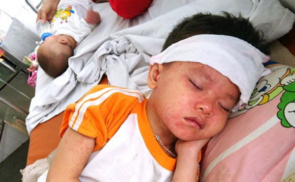 Bệnh sởi: Trong điều kiện độ ẩm tăng cao, không khí ẩm mốc, vi khuẩn, vi-rút gây bệnh sởi dễ sinh sôi nảy nở. Bệnh sởi lây qua đường hô hấp, có thể bùng phát trên diện rộng nếu không có biện pháp phòng ngừa hợp lý.