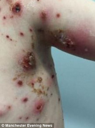 Hayley Lyons cho biết, tình trạng của con trai xấu đi rõ rệt sau khi dùng thuốc ibuprofen. Hayley Lyons cảnh báo, các bậc cha mẹ không được cho con dùng thuốc này khi bị thủy đậu vì "nó phản ứng với thủy đậu và khiến virus đi sâu hơn vào các tế bào da".