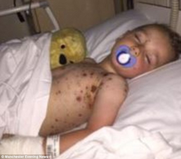 Bé Lewis được nhập viện trong tình trạng nhiễm trùng máu nặng. Các bác sĩ Bệnh viện Nhi Alder Hey đã điều trị kịp thời và giúp bé vượt qua cơn nguy kịch.