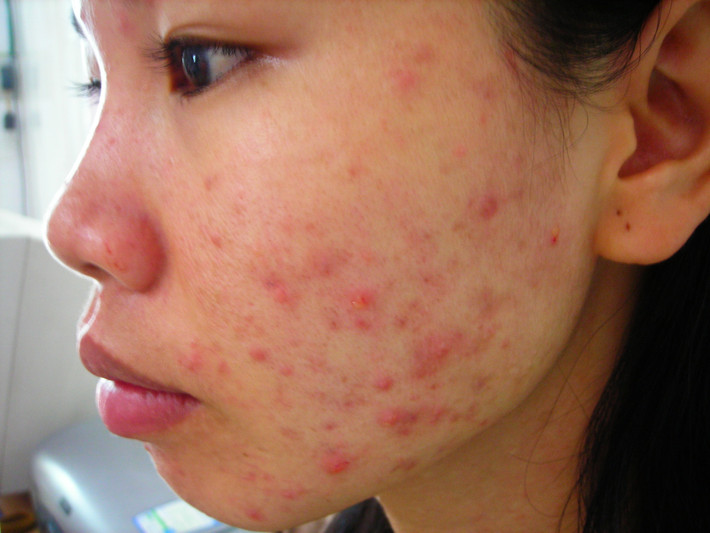 Bụi không khí do ô nhiễm là tác nhân gây các bệnh về da liễu như mụn, dị ứng, viêm da…